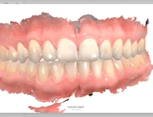 El escáner intraoral revoluciona la clínica